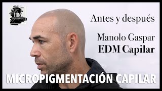 Micropigmentación Capilar en Famosos  Manolo Gaspar futbolista profesional [upl. by Aynotahs]