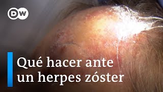 Primero varicela luego herpes zóster [upl. by Atiluj]