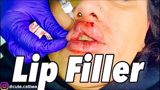 Lip Filler Full Video With BEFORE and AFTER [upl. by Waldon606]