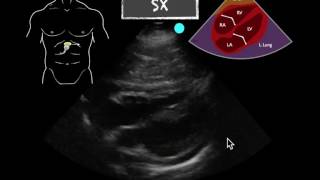 POCUS Teaching Point Pericardial effusion [upl. by Eustatius146]