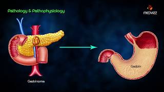 ZollingerEllison syndrome ZES  Animated lecture usmle step 1 pathology  Dr Bhanu prakash [upl. by Worthy]