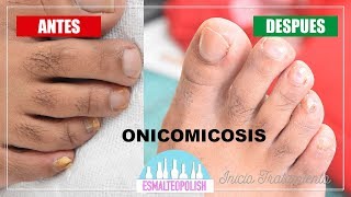 Onicomicosis Eliminar hongo de las uñas  Esmalteopolish [upl. by Oj]