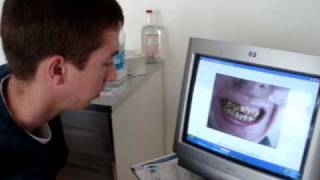 porcelain crowns veneers Tijuana Medical Tourism [upl. by Dleifyar]