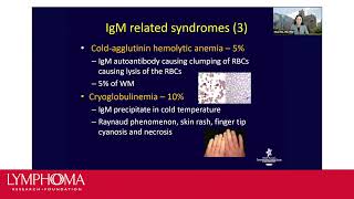 Waldenstrom Macroglobulinemia [upl. by Nnyleitak]