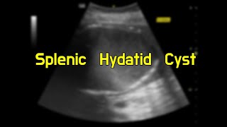 Splenic Hydatid Cyst [upl. by Adolph79]