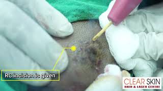 Nevus Sebaceous Of Jadasohn Removal By RC Excision Treatment  Clear Skin Hair and Laser Centre [upl. by Ojimmas]