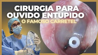 CIRURGIA PARA OUVIDO ENTUPIDO  O FAMOSO CARRETEL NO OUVIDO [upl. by Jeffries]