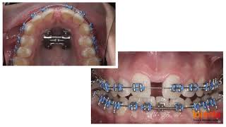 Evolución del tratamiento de ortodoncia con brackets en menos de 1 minuto [upl. by Ferde]