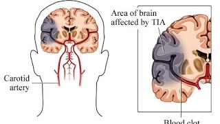 Transient Ischemic Attack TIA [upl. by Cleodal]