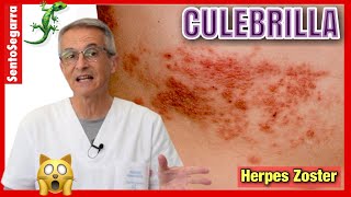 CULEBRILLA 👉 ¿Por qué Hay AHORA más CASOS ✴️ HERPES ZOSTER [upl. by Ielarol152]