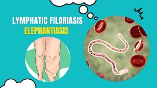 Unlocking the Secrets of Elephantiasis What You Need to Know [upl. by Pascale]