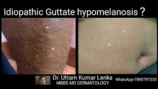 White spots on skin in old age idiopathic guttate hypomelanosis Treatment and prevention [upl. by Samuella297]