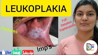 LEUKOPLAKIA  PREMALIGNANT LESION [upl. by Mochun844]