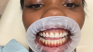 Getting veneers in America Vlog pt 1 [upl. by Eulau]