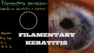 Filamentary Keratitis  Ophthalmology [upl. by Brannon346]