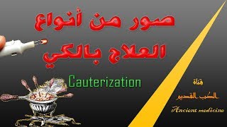 الكي  صور من أنواع العلاج بالكي  Cauterization [upl. by Kessia]