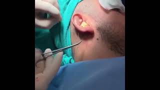 Otoplasty Surgery Under Local Anesthesia [upl. by Hattie]