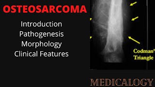 OSTEOSARCOMA PATHOLOGY Bone Tumors [upl. by Nnaylime]