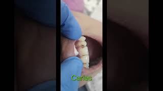 Caries teeth treatment done with finishing and polishingdentist toothdental cosmeticdentistry [upl. by Rosanna]