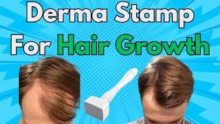 This Is Why You Should Add A Derma Stamp To Your Hair Growth Routine  Derma Stamp x Minoxidil Combo [upl. by Aulea]