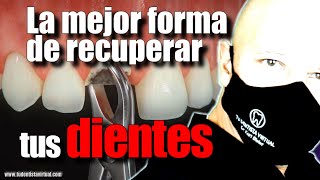 LOS IMPLANTES DENTALES CAMBIARON ¿LO SABÍAS [upl. by Belter]