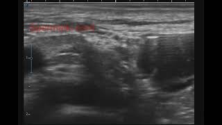 Inguinal canal block ultrasound [upl. by Winshell]