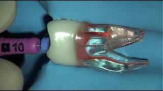 Cleaning and shaping root canals using the iRace sequence [upl. by Ailaham]