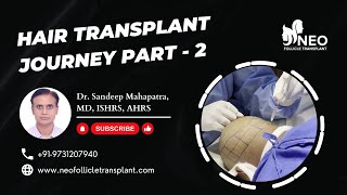 Part 2 Extraction of Grafts  Hair Transplant Journey  Neo Follicle Hair Transplant Bangalore [upl. by Theobald908]