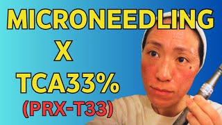 Microneedle with me using NOPEEL TCA33 PRXT33 │Acne scar treatment [upl. by Audette]