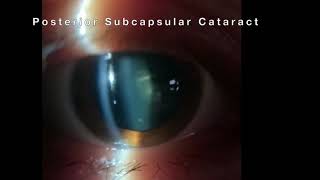 Posterior Subcapsular Cataract PSC [upl. by Ardenia]