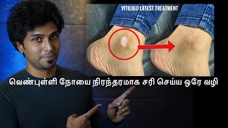 வெண்புள்ளி நோயை நிரந்தரமாக சரி செய்ய ஒரே வழி  Vitiligo treatment live process in Tamil [upl. by Thirza]