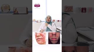 Seborrheic Dermatitis  Dr Lamyaa Wadgy  Burjeel Hospital Al Khuwair  Muscat [upl. by Yraccaz307]