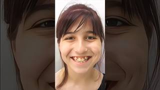 Smile change with braces dentist orthodontist dentalclinic [upl. by Eibbob]