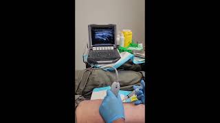 Pes Anserine bursitis injection under ultrasoundguidance [upl. by Anissa]