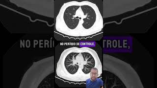 Tc de tórax para avaliação de nódulos pulmonares [upl. by Trebuh]