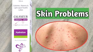 Skin problems control with Calamine lotion [upl. by Henrie563]