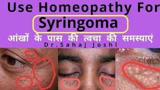 syringoma homoeopathic treatment [upl. by Nimajeb]