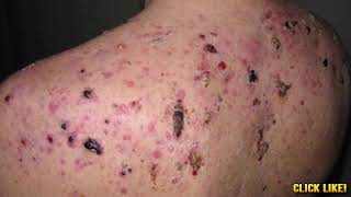 Worst Pops Cysts Zits Pimples amp Blackhead Popping [upl. by Etnoled]