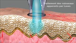 Traitement couperose par laser vasculaire  dermolaser toulouse [upl. by Bashuk]