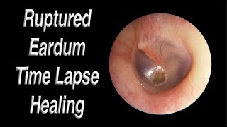 Ruptured Eardrum Healing Closed Time Lapse  A Hole in Eardrum Usually Heals Closed on Its Own [upl. by Barren]