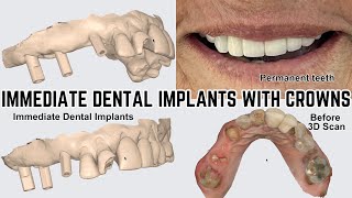 Dental implant front teeth  Upper jaw Full Arch Immediate Dental Implants  Before and After [upl. by Mannos]