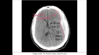 Intracranial Bleed  Part 4 [upl. by Ahsrav63]