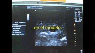 Abordaje Posterior Vena Yugular Interna con Ultrasonido [upl. by Leinoto]