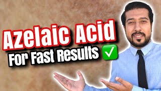 Azelaic Acid for Melasma  How to Use Azelaic Acid for SUCCESS 🏆 [upl. by Anala284]