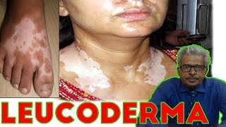 Safed Daag Ka Ilaj  Vitiligo Treatment At Home  White Spots On Skin Home Remedies in Hindi [upl. by Kegan]