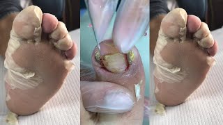 Satisfying Deep Foot Corn and Callus Removal  Watch the Magic Unfold [upl. by Freddi]