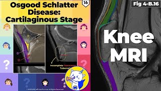 Fig 4B16 Osgood Schlatter Disease Cartilaginous Stage [upl. by Eemak]