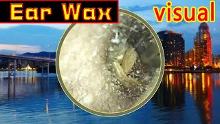 Ear wax removal amp Ear Cleaning （6） [upl. by Howes]