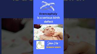 Anencephaly sonography  Dr Sudhanshu Tandon youtubeshorts 3dultrasound [upl. by Gibert]