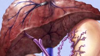 TIPSS Transjugular Intrahepatic PortoSystemic Shunt [upl. by Toh]